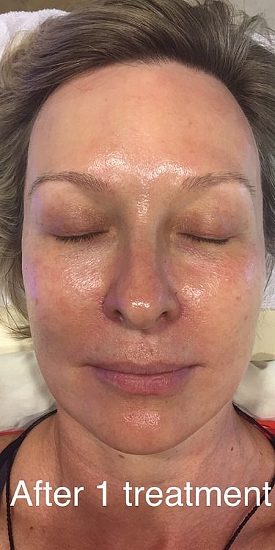 Hydrafacial Before & After